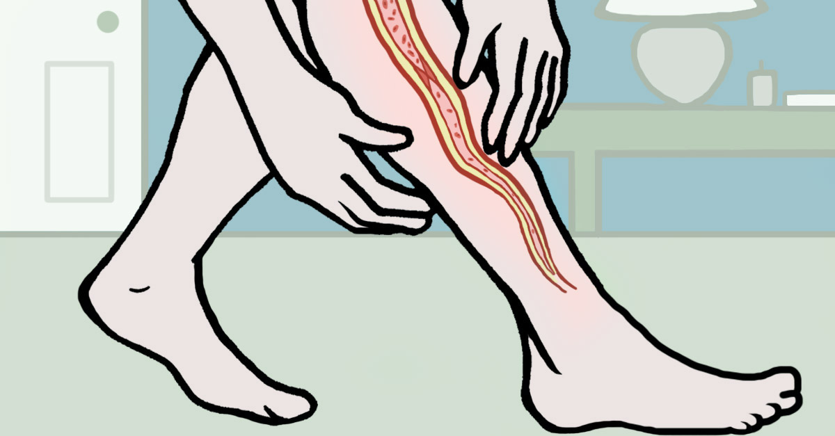 Blood Clot Risks And Symptoms You Need To Know