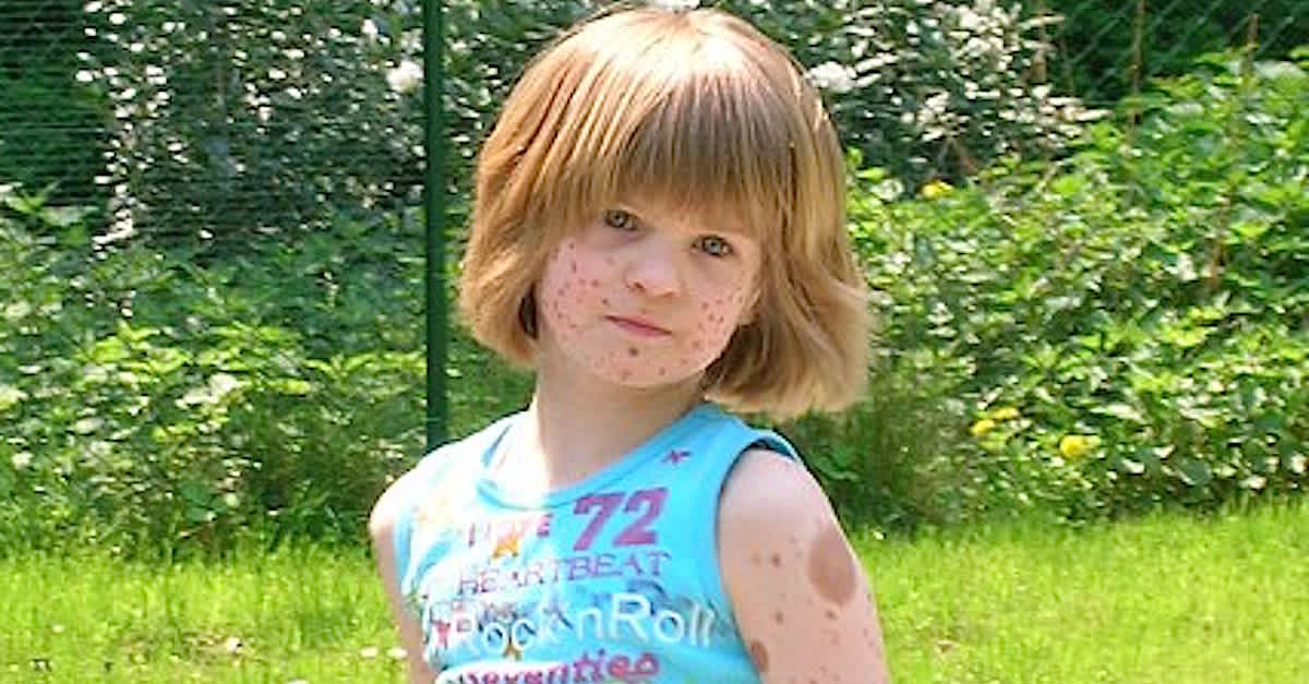 Girl Whos Bullied Over Her Birthmarks Grows Up To Be A Model