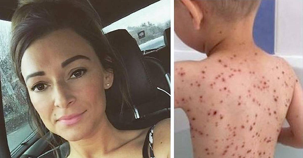 Mom Warns Parents Against Giving Ibuprofen To Kids With Chickenpox