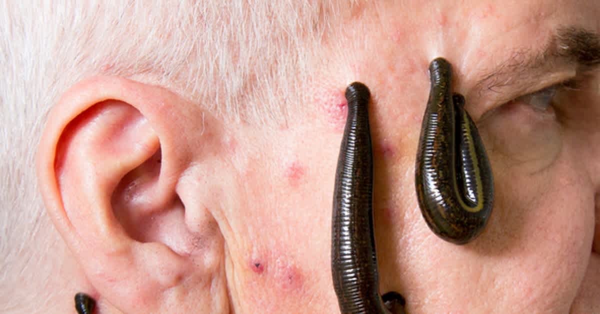 Are leeches being used in modern medicine?