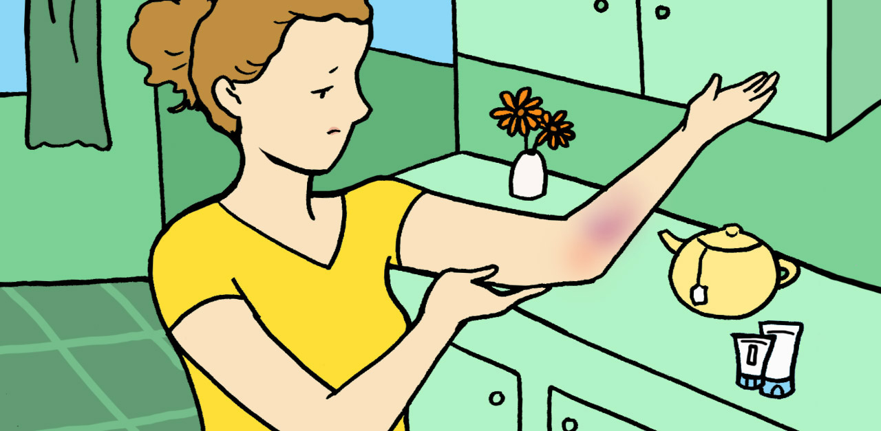 How To Get Rid Of Bruises Fast Using Home Remedies