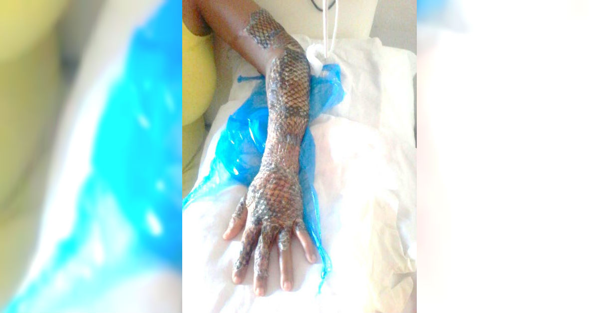 do doctors use fish skin on burn victims