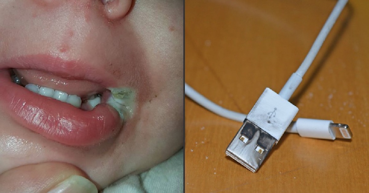 Mom Shares Photos Of Baby's Burn From Charger