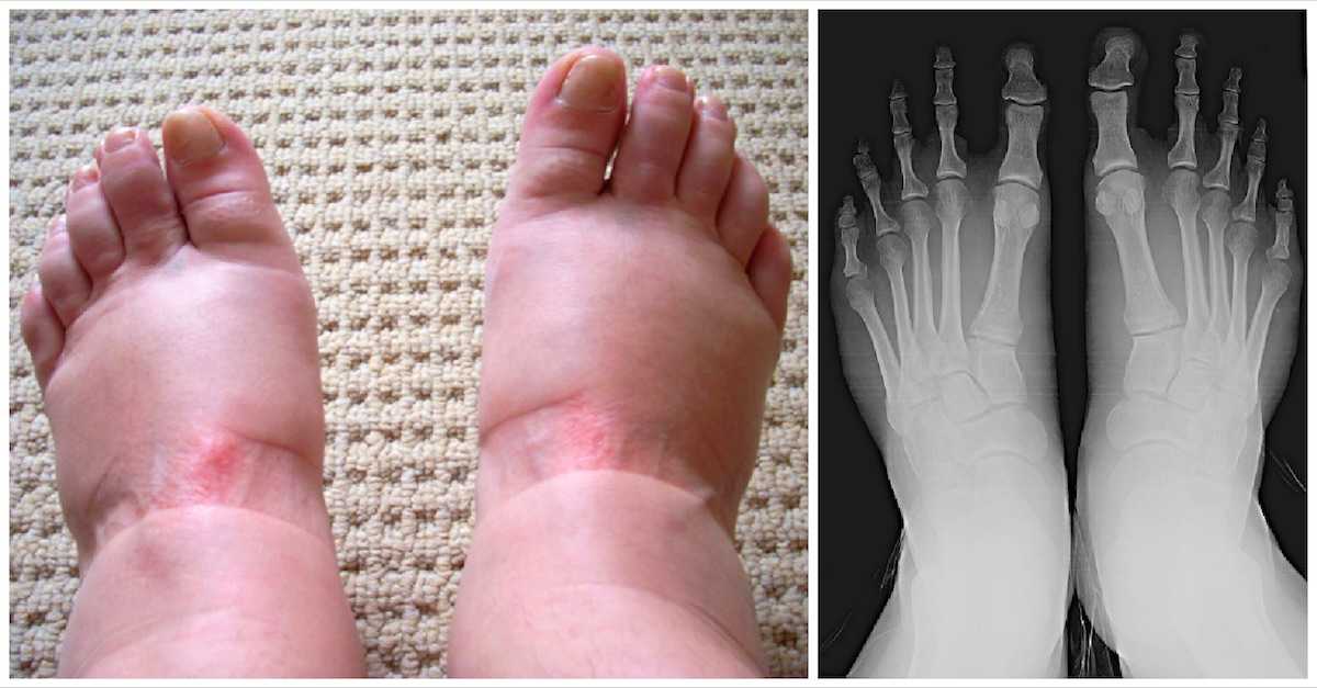 8 Alarming Medical Conditions That Can Give You Swollen Feet Littlethings Com 8 Alarming Medical Conditions That Can Give You Swollen Feet Littlethings Com