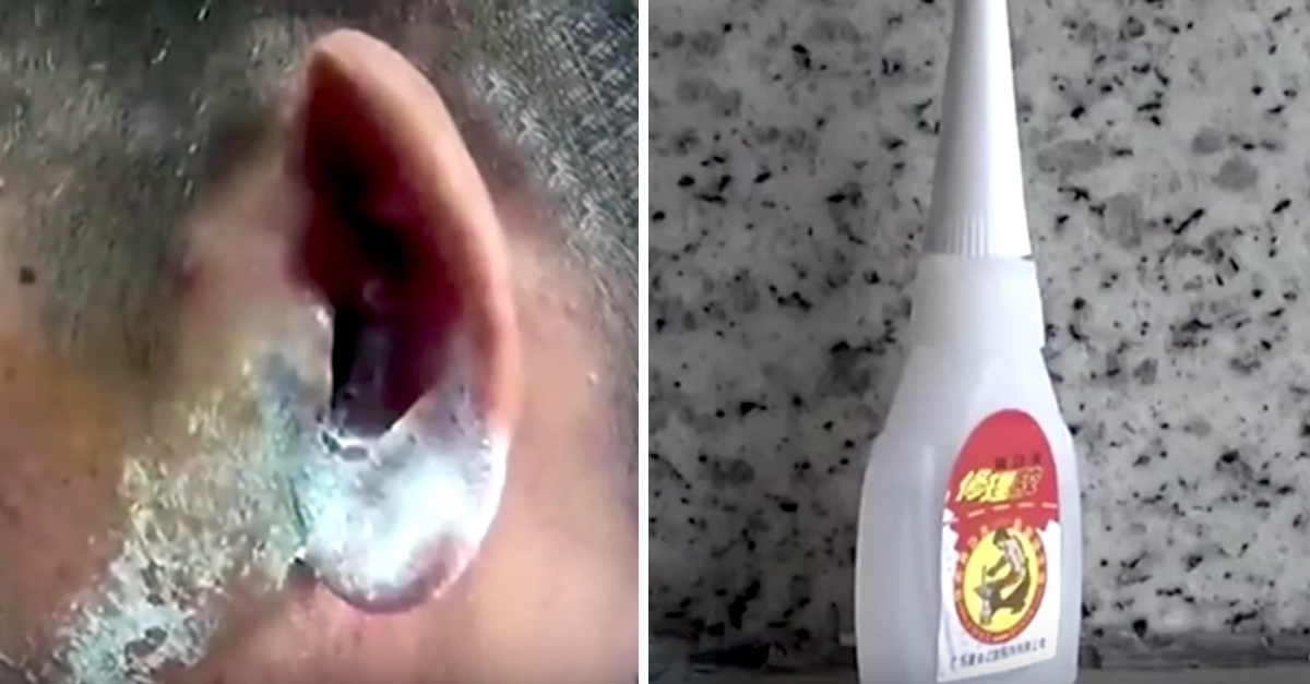 Man Puts Superglue In Ears Instead Of Ear Drops