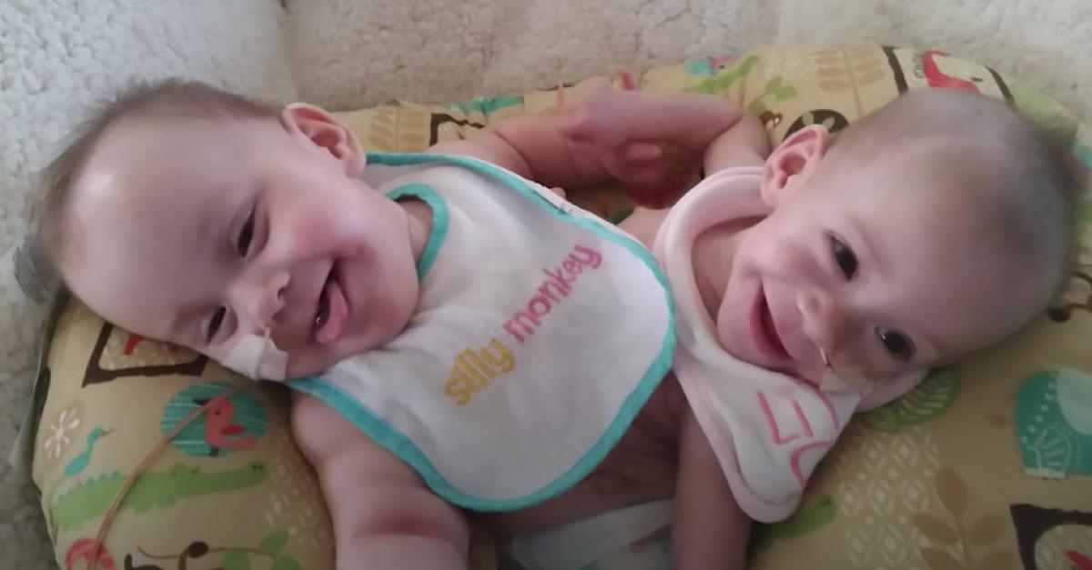 Conjoined Twins Are Thriving After Surgery To Separate Them ...