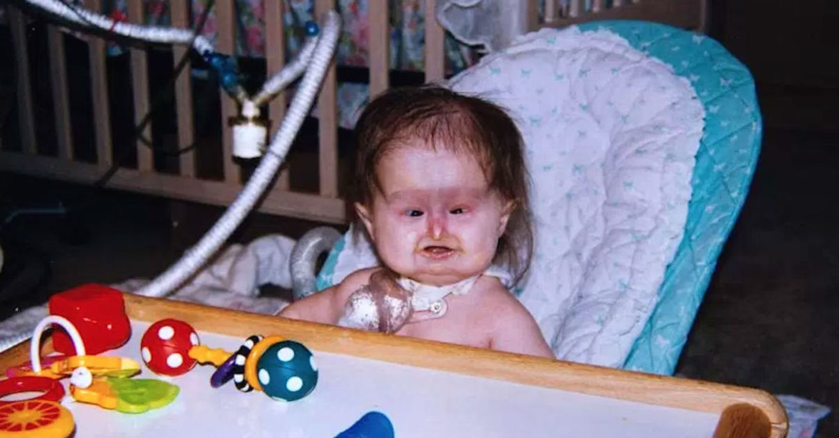 Young Woman With Rare Condition Is Mistaken For A Baby