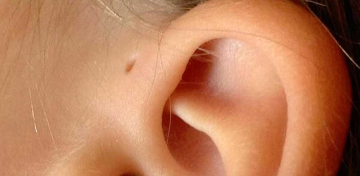 tabe sammenbrud Trafikprop The Fascinating Reason Why Some People Have A Small Hole Above Their Ear |  LittleThings.com