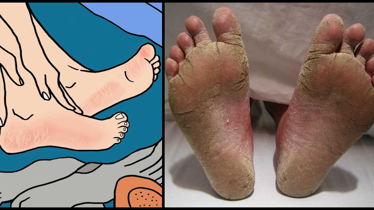 7 Alarming Reasons You Have Peeling Or Cracked Feet Littlethings Com 7 Alarming Reasons You Have Peeling Or Cracked Feet Littlethings Com