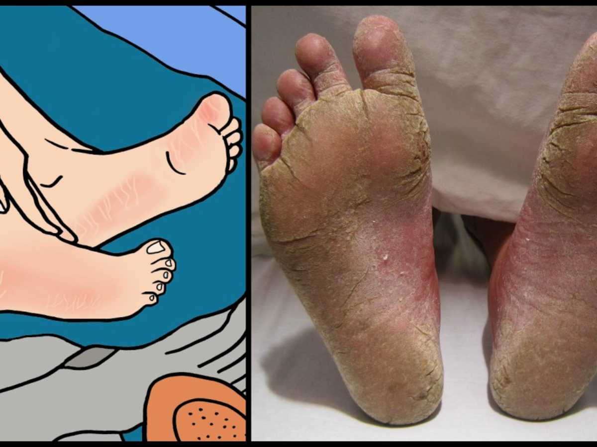 7 Alarming Reasons You Have Peeling Or Cracked Feet Littlethings Com 7 Alarming Reasons You Have Peeling Or Cracked Feet Littlethings Com