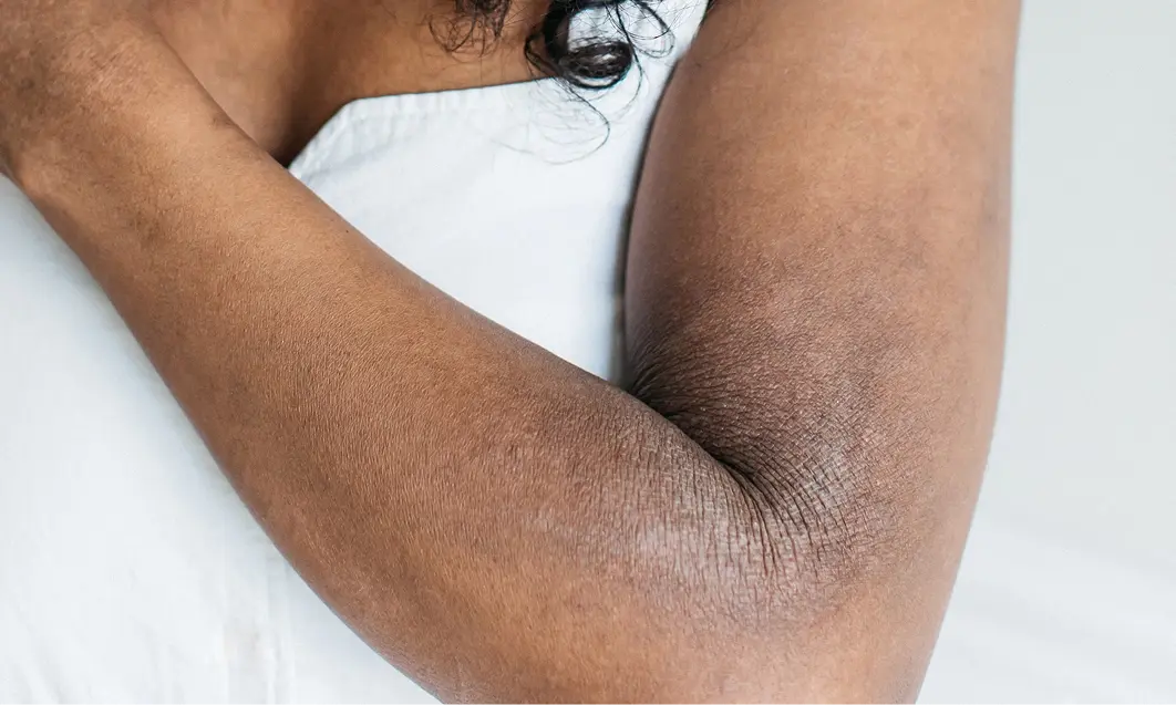  Image featuring an arm highlighting a dry skin condition