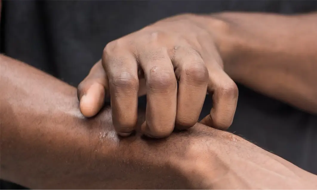 A person scratching their arm, highlighting an itchy and dry skin condition