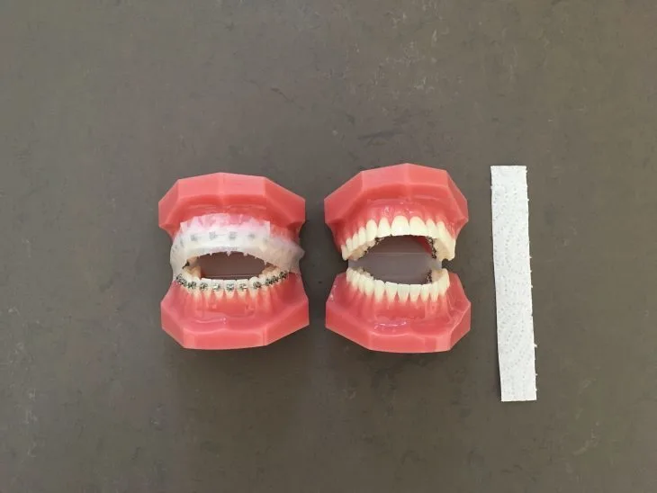 Zahnspangenmodelle mit Brackets und Stück Küchenrolle