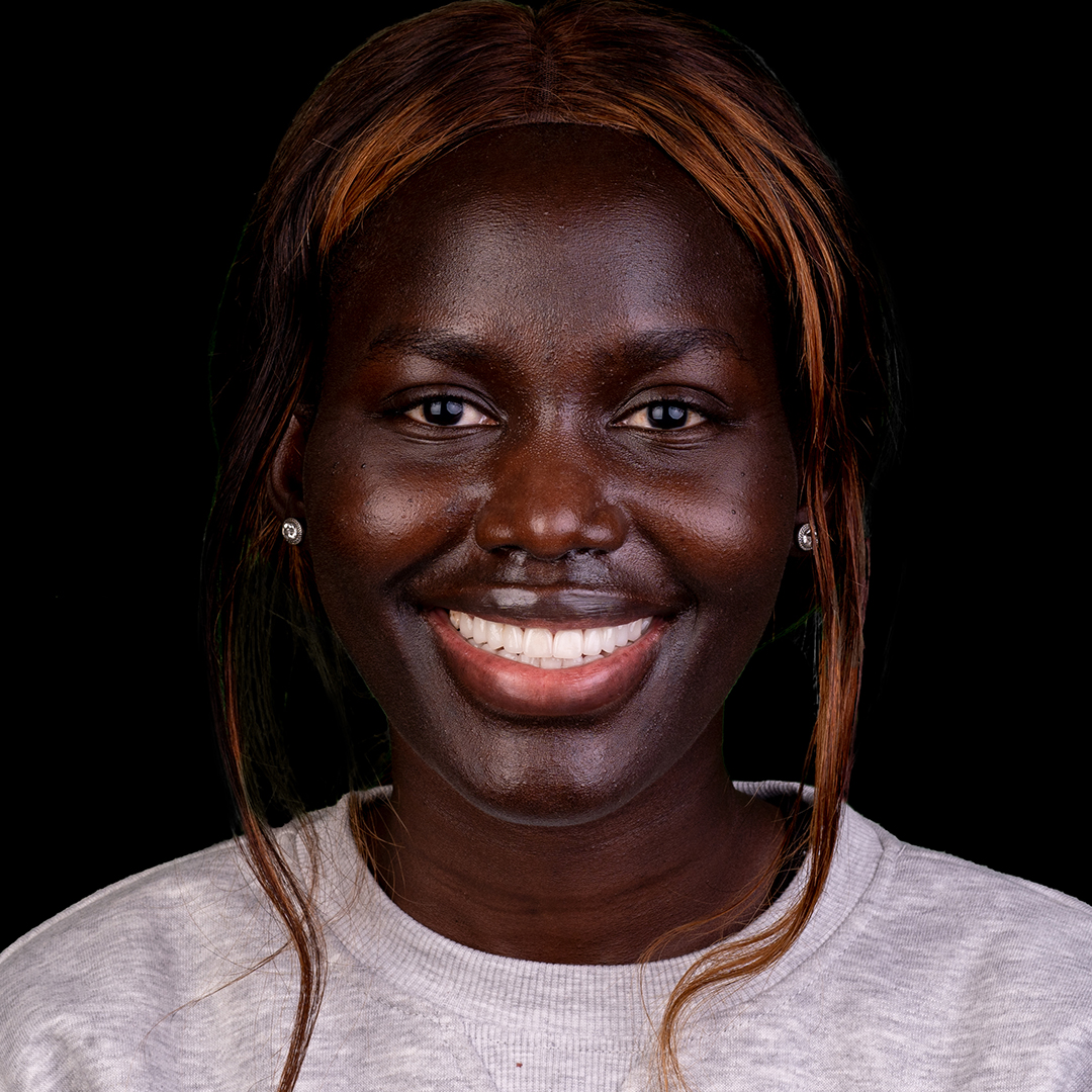 Isara natural veneers smile makeover at Bring Back a Smile Foundation
