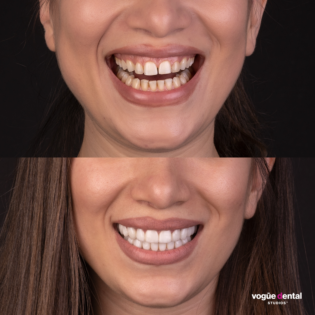 Before and after porcelain veneers at Vogue Dental Studios - Cropped Face View Mina