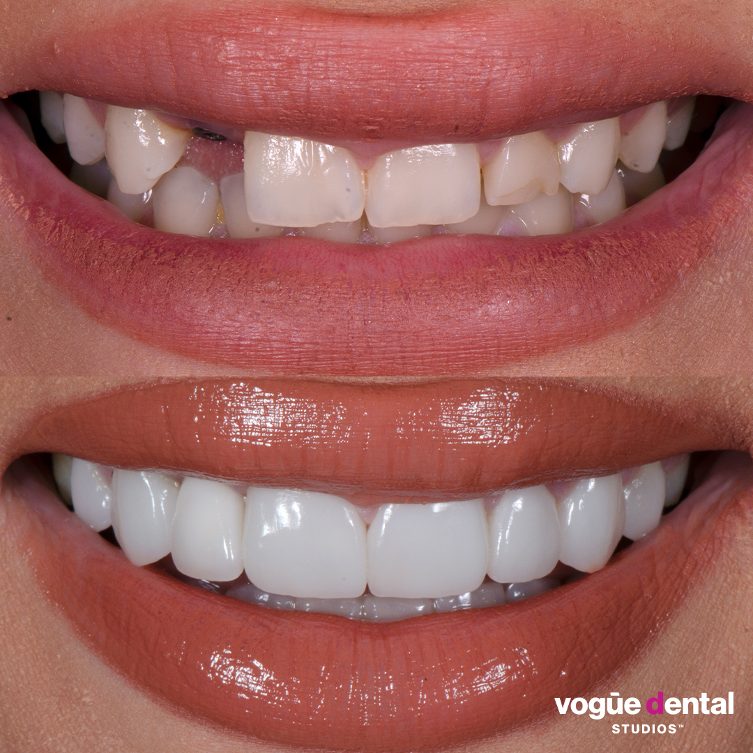 Before and after porcelain veneers at Vogue Dental Studios - Front View Tijanna