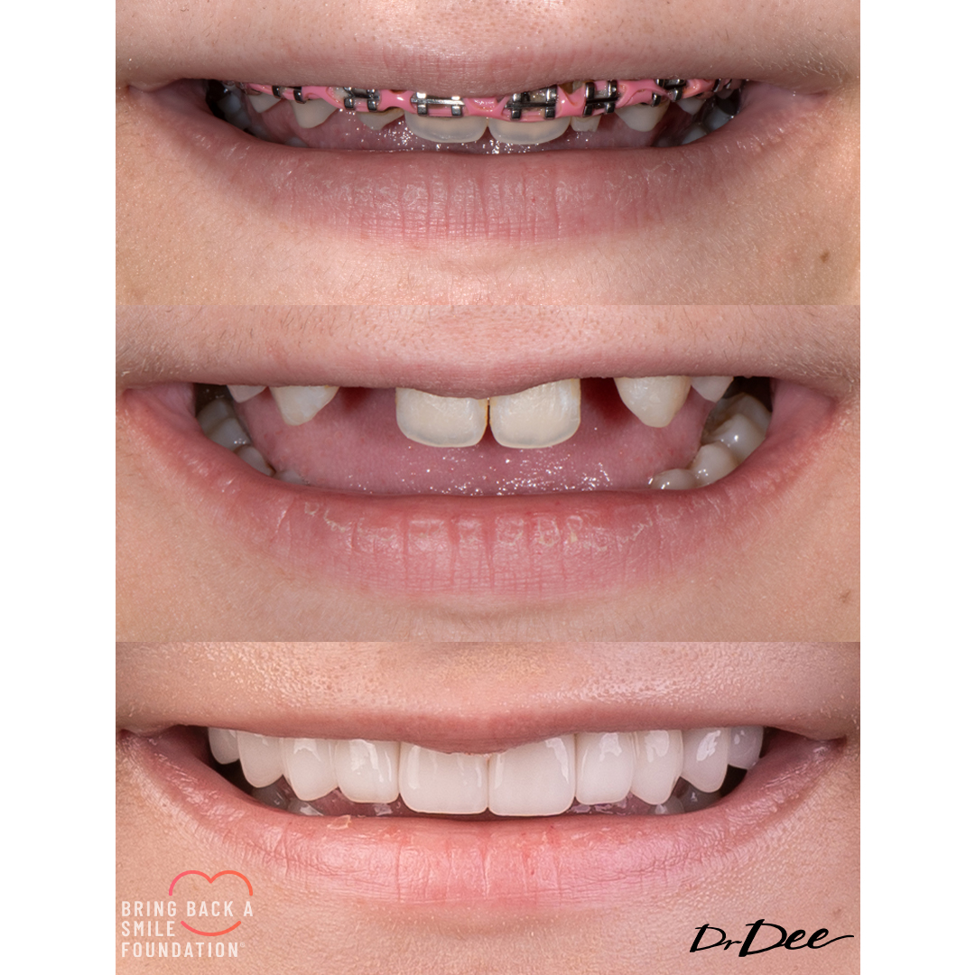 Bring back a smile foundation before and after veneers missing laterals