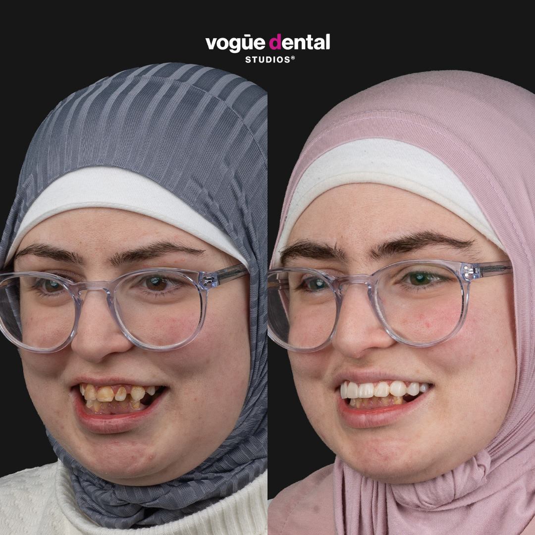 Rabab crooked teeth smile makeover before and after at Bring Back a Smile Foundation