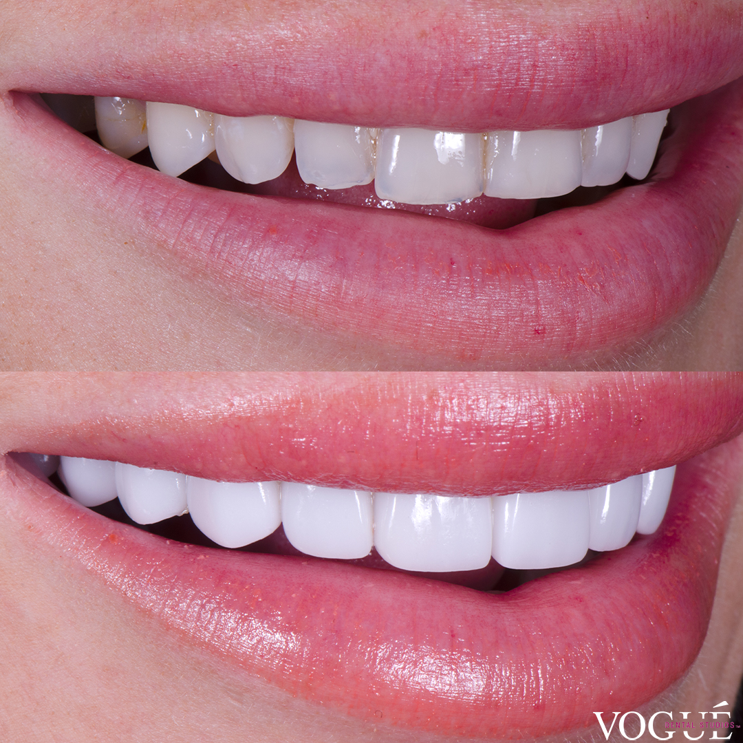 Before and after porcelain veneers smile makeover at Vogue Dental Studios - left teeth view Tash Herz.