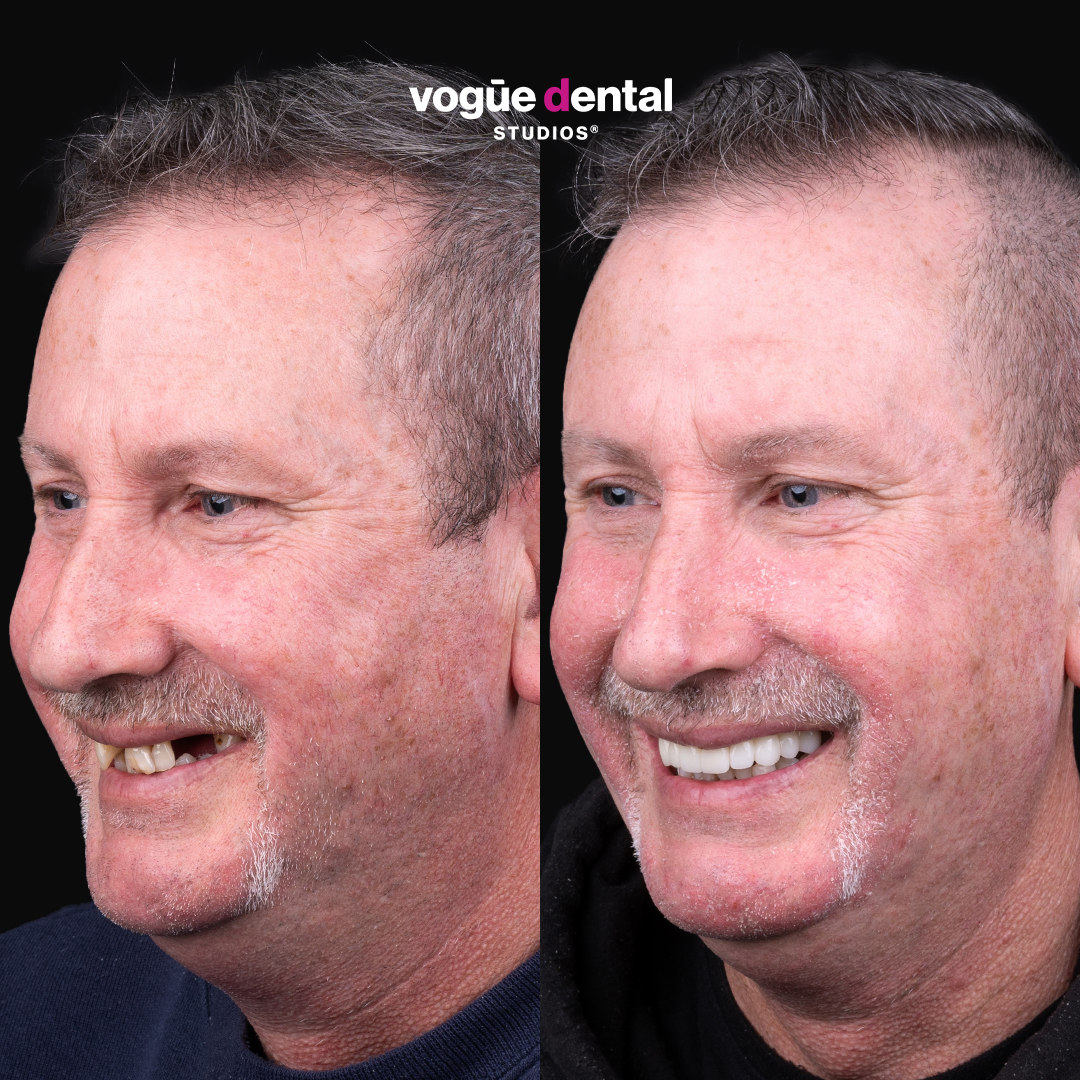 David several missing teeth smile restoration from smile makeover giveaway at Vogue Dental Studios