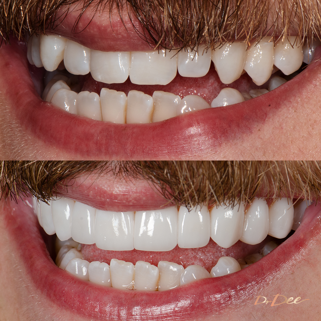 Before and after porcelain veneers at Vogue Dental Studios - Michael left teeth view