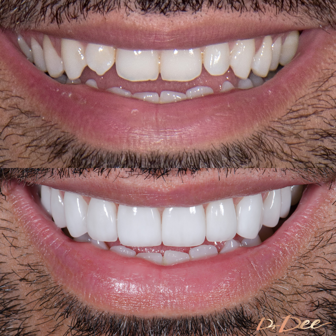 Before and after porcelain veneers at Vogue Dental Studios - Farzin