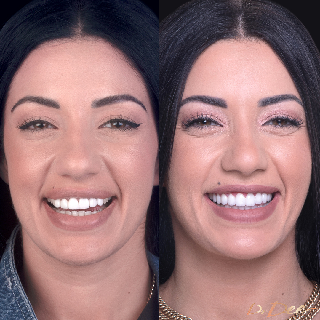 Tash Herz before and after porcelain veneers smile makeover at Vogue Dental Studios.