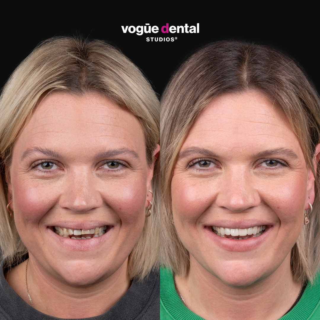 Clare before and after smile makeover giveaway at Bring Back a Smile Foundation
