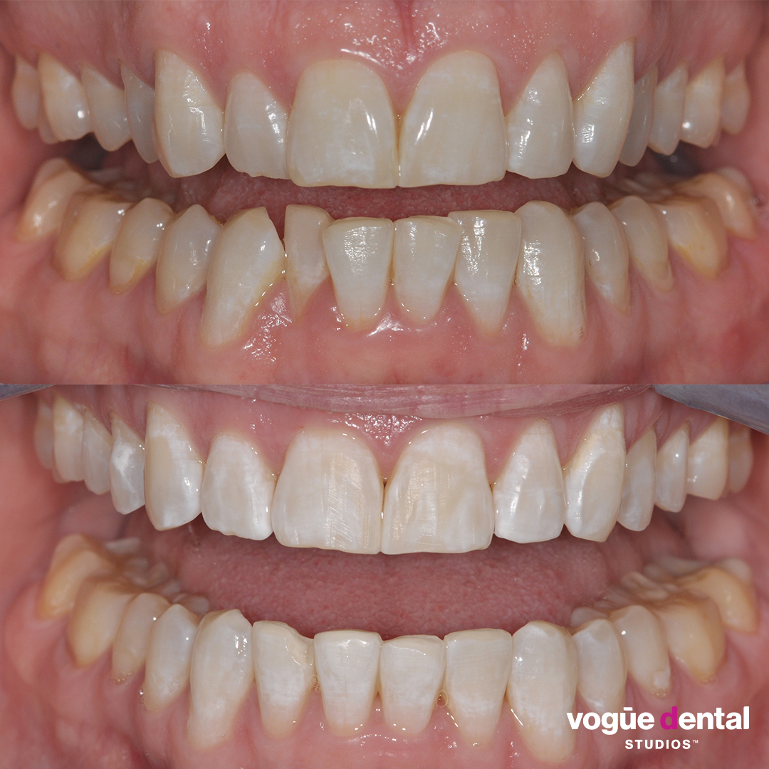 Before and after Invisalign Lite at Vogue Dental Studios - front retracted view Shura.