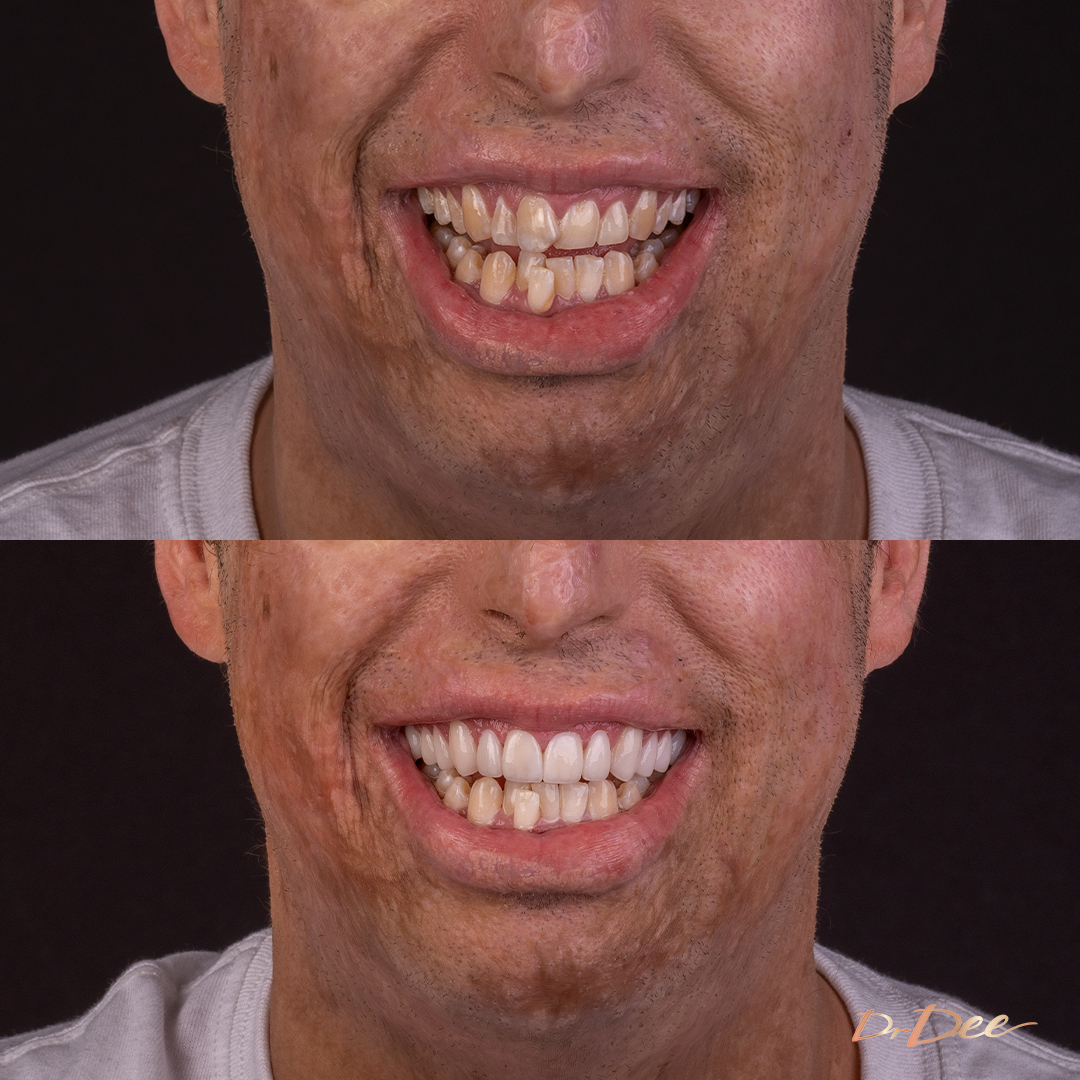 Christopher burn victim before and after smile makeover at Bring Back a Smile Foundation