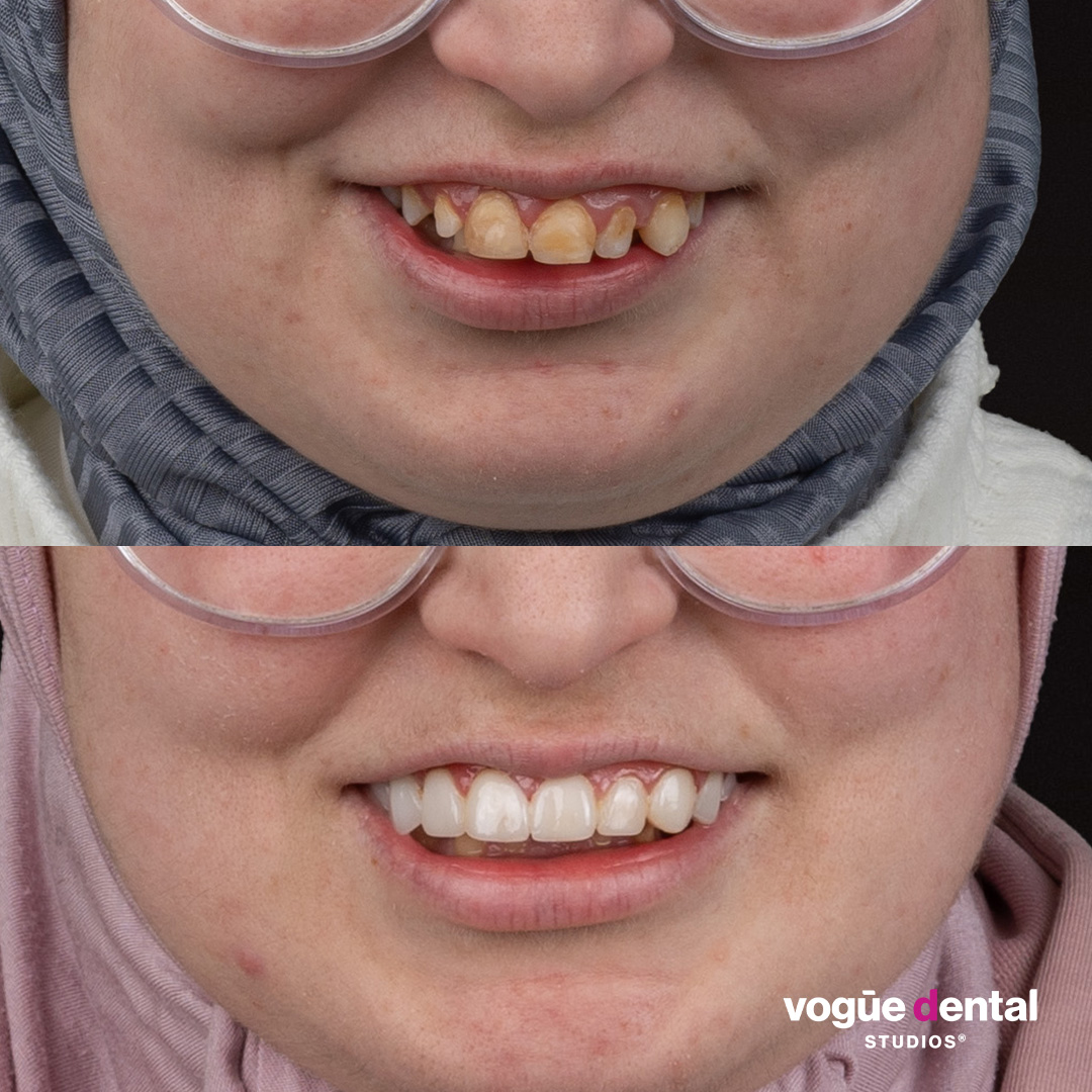 Rabab crooked teeth smile makeover before and after at Bring Back a Smile Foundation