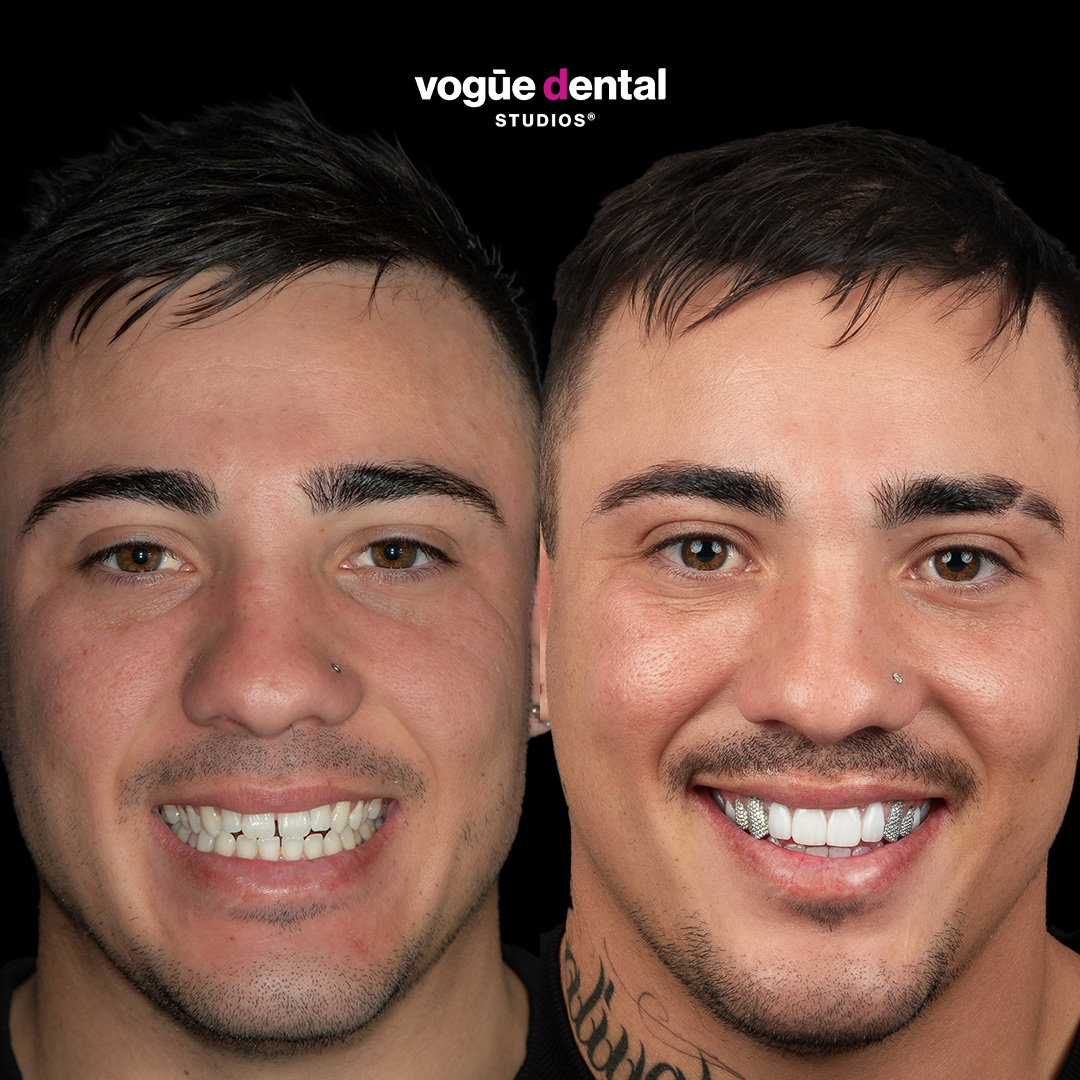 Before and after porcelain veneers and diamond crowns at Vogue Dental Studios - Michael