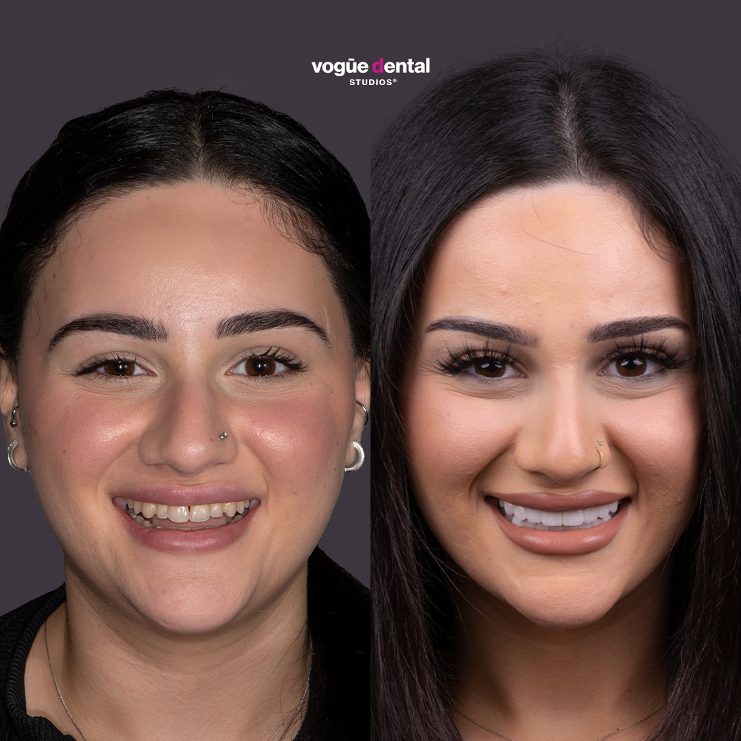 Before and after chipped teeth with porcelain veneers at Vogue Dental Studios - front view Mariana.