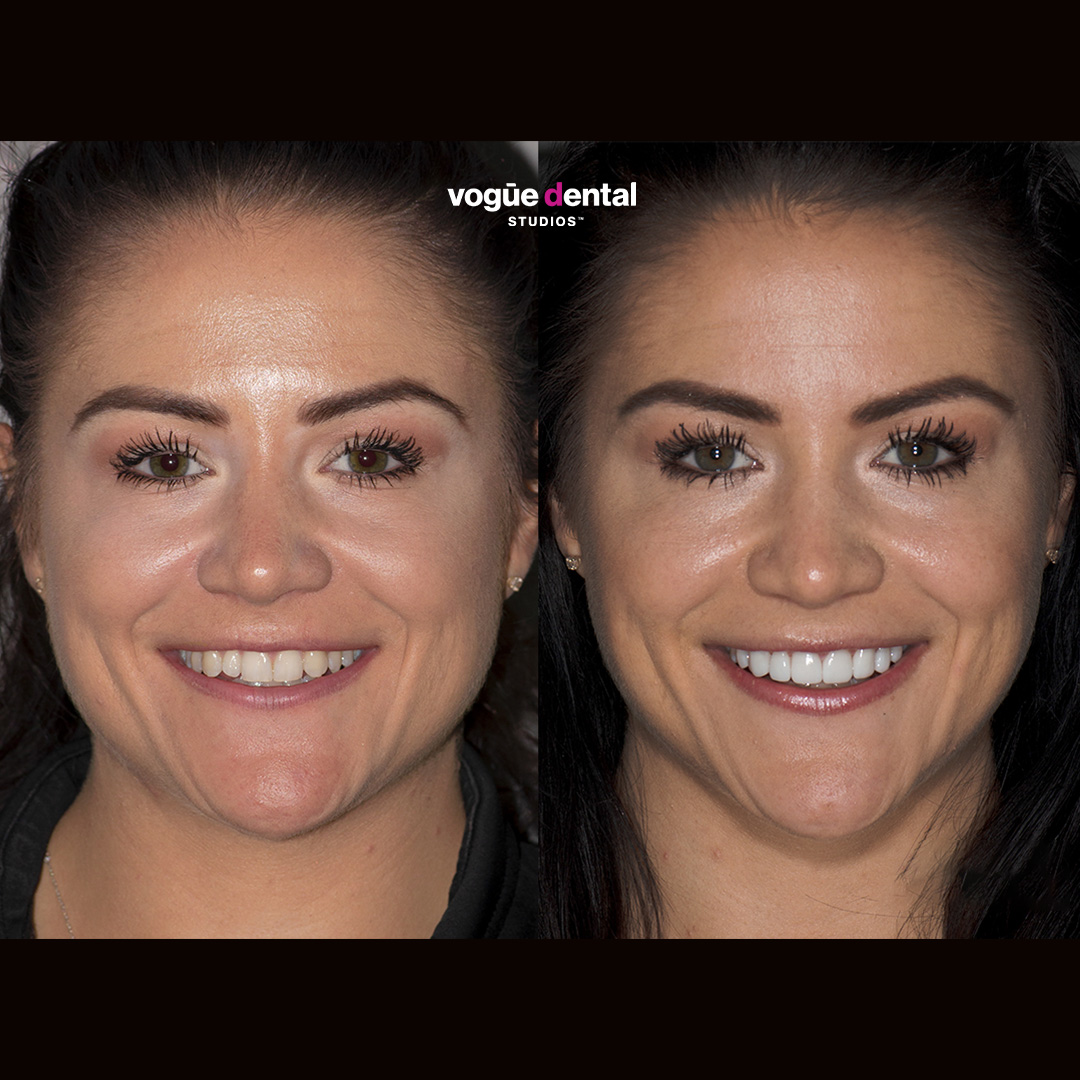Before and after smile makeover porcelain veneers at Vogue Dental Studios - front face view Amy.