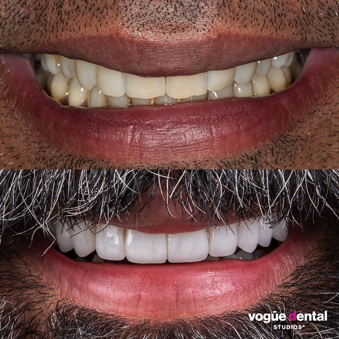 Before and after small and uneven smile with porcelain veneers at Vogue Dental Studios - face view Nav.