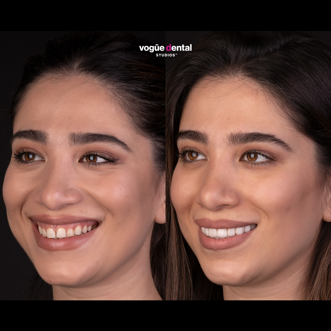 Before and after porcelain veneers at Vogue Dental Studios - Side Face View Mina