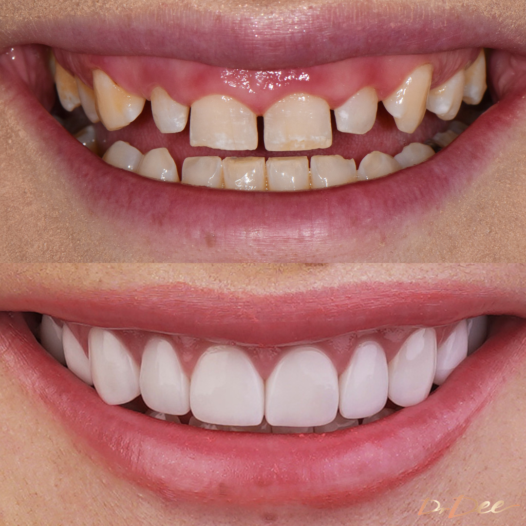 Marina gummy smile with gaps before and after veneers at Bring Back a Smile Foundation