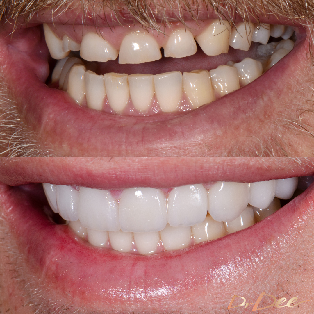 Jake Edwards smile makeover left teeth view.