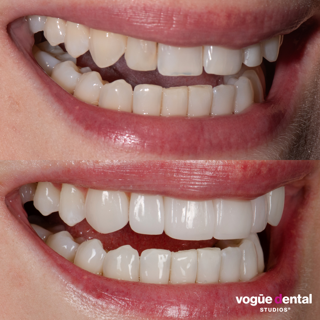 Before and after with Picasso Ultra Hybrid veneers at Vogue Dental Studios - side teeth view Eve.