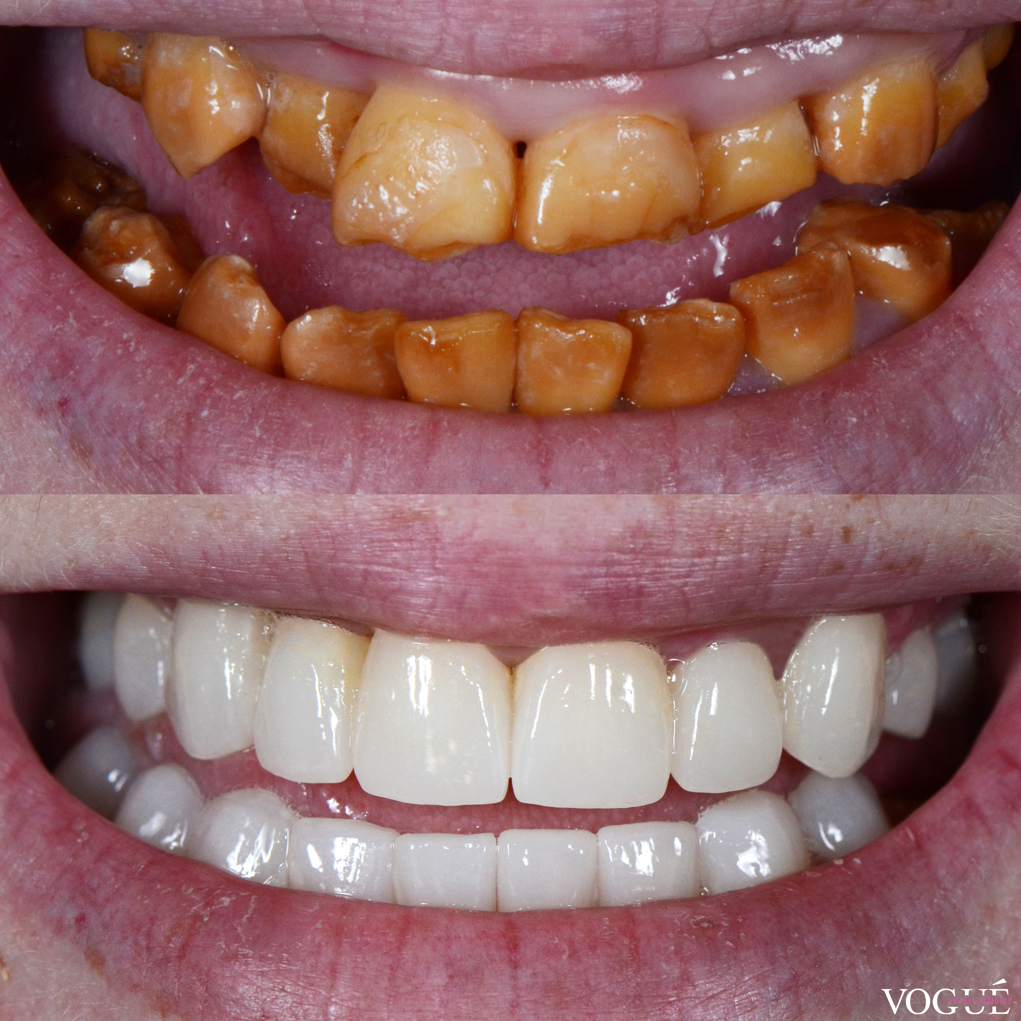 Jacinta, a Bring Back a Smile beneficiary before and after results comparison.