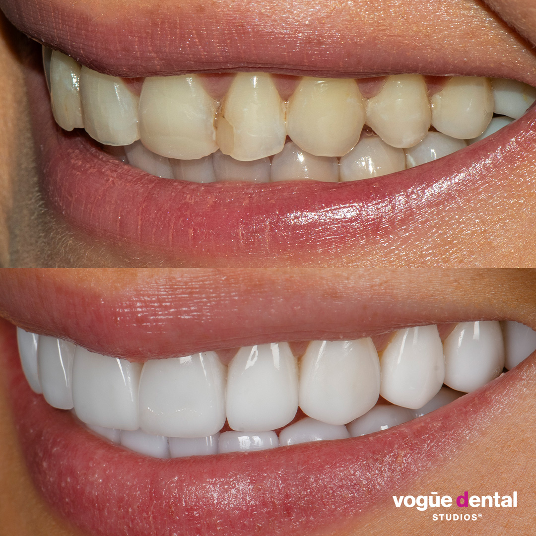 Before and after with Picasso Porcelain veneers at Vogue Dental Studios - left side teeth view Dzenana.