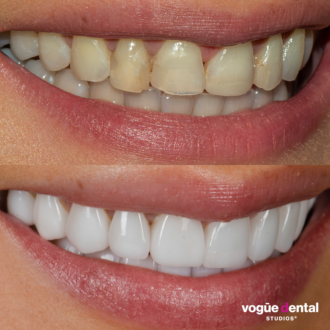 Before and after with Picasso Porcelain veneers at Vogue Dental Studios - right side teeth view Dzenana.