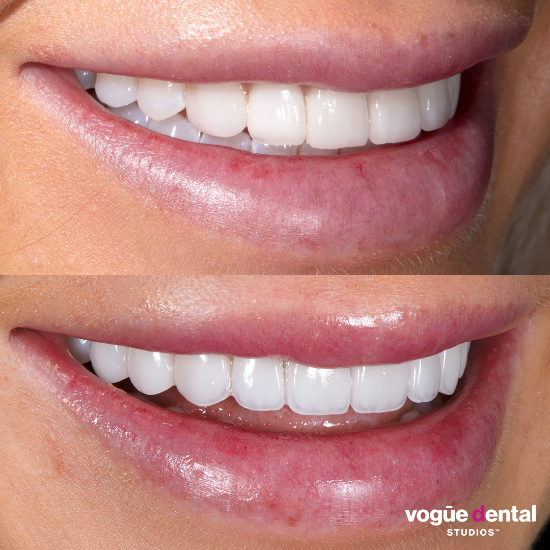 Before and after porcelain veneers smile makeover at Vogue Dental Studios - right teeth view Elise