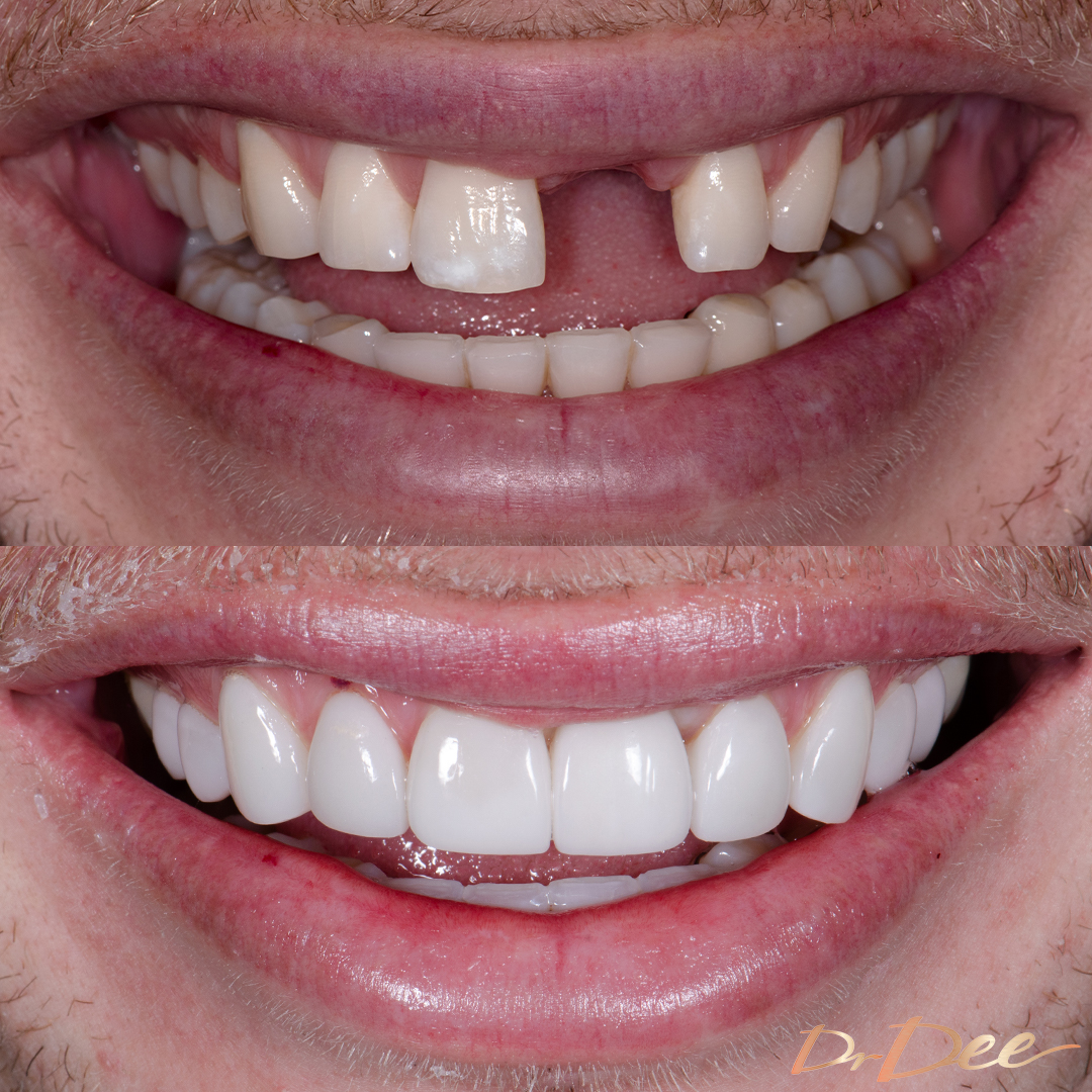 Before and after porcelain veneers and implant smile makeover at Vogue Dental Studios - front teeth view Sam G