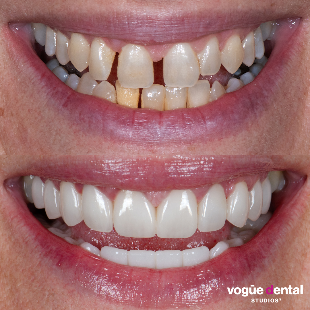 Before and after porcelain veneers at Vogue Dental Studios - front teeth view Anita