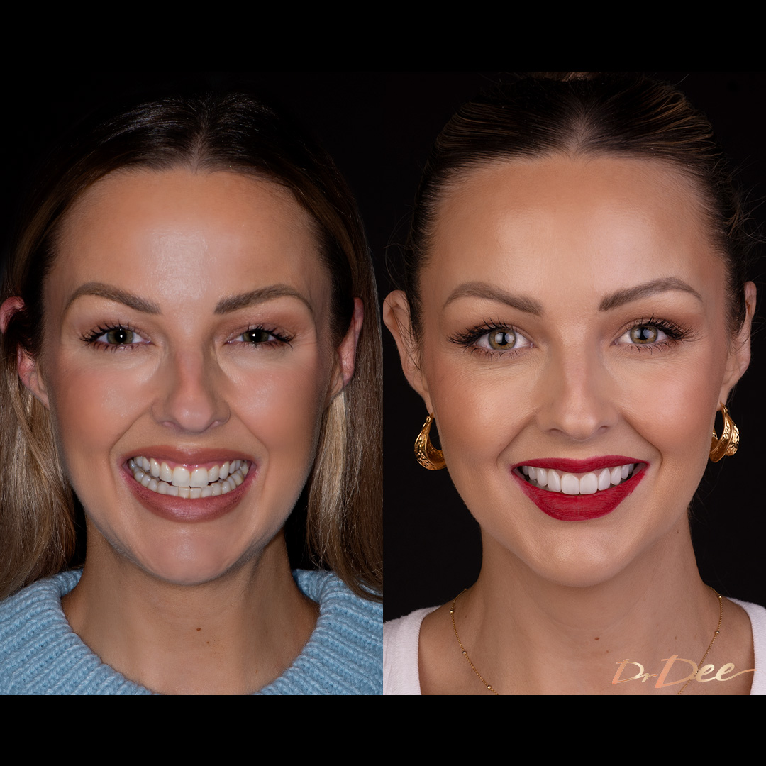 Before and after porcelain veneers Rachael De Olivera - front face view