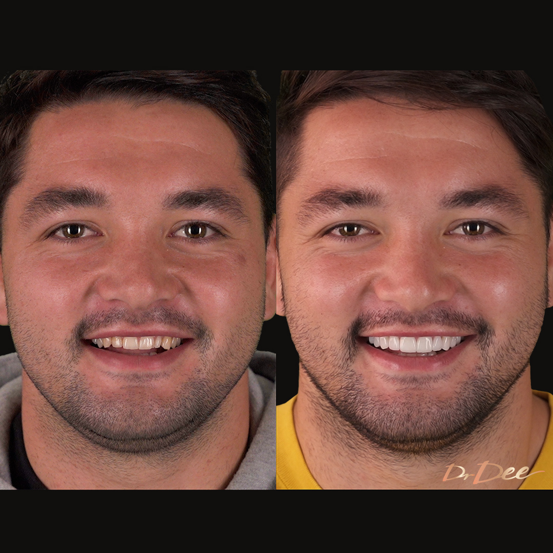 Brandon Smith before and after porcelain veneers at Vogue Dental Studios.