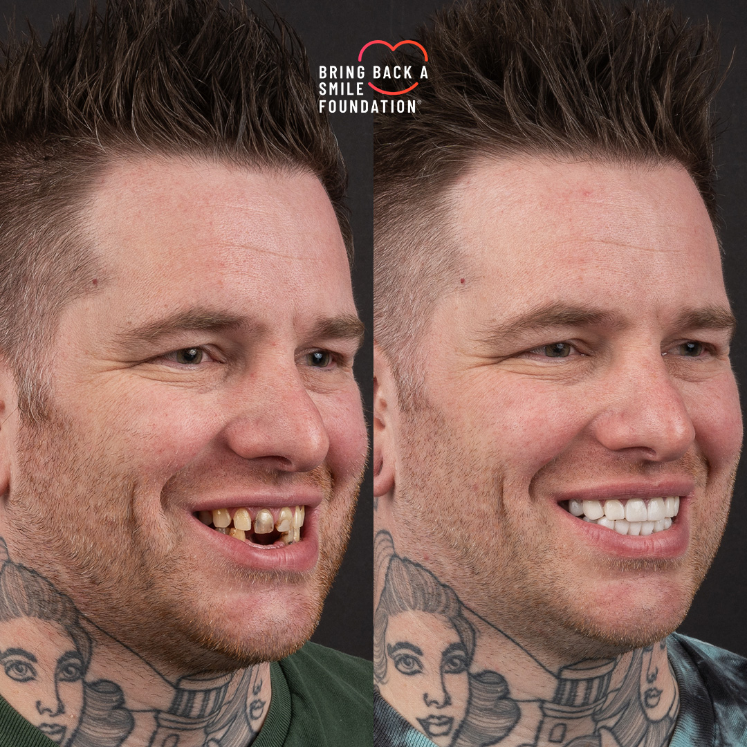 Before and after missing teeth with porcelain veneers at Vogue Dental Studios - side view Josh