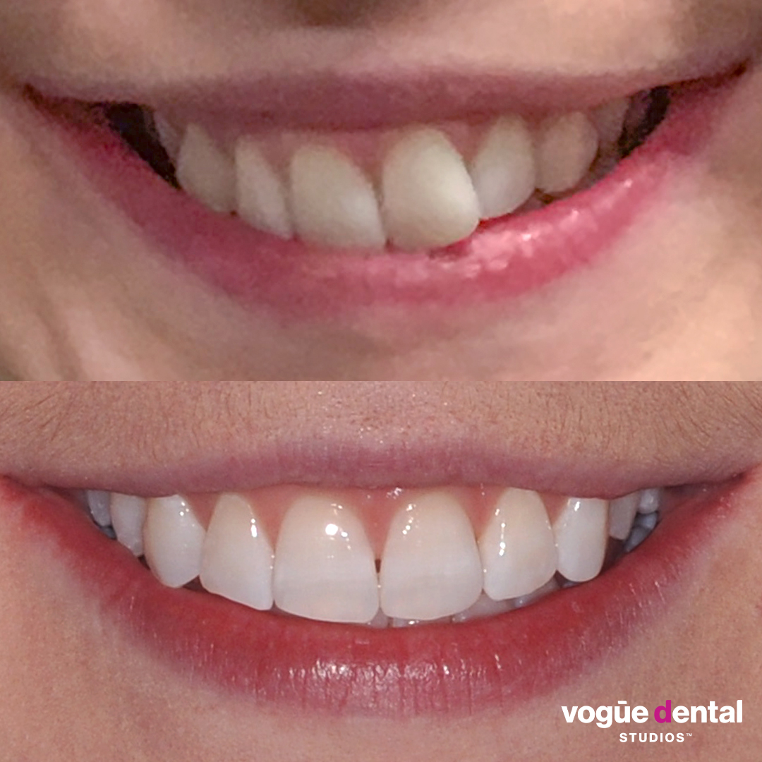 Before and after Invisalign full and teeth whitening at Vogue Dental Studios - front face cropped view Ashea.