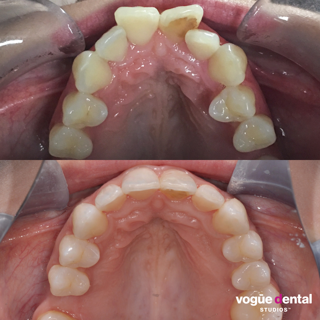 Before and after Invisalign Full at Vogue Dental Studios - Uppers - Sharni